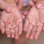 Manuel ayak hastalığının belirtileri nelerdir? El ayak hastalığı nasıl anlaşılır? Tedavi yöntemleri nelerdir?